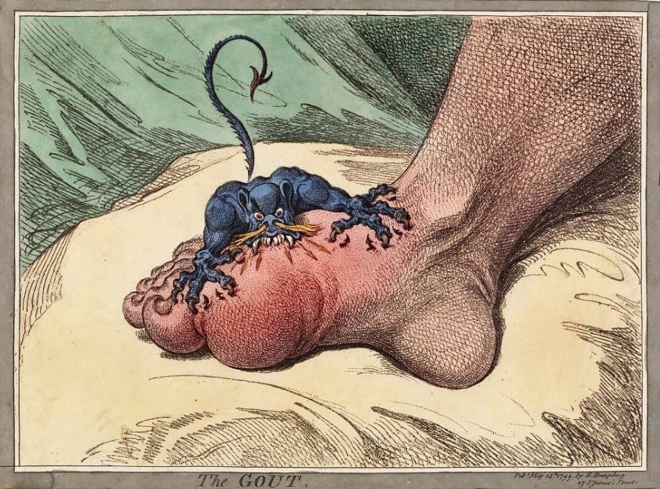 La gota 1799. Segun el ilustrador y caricaturista británico James Gillray